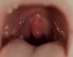 Image result for Physical injury red spots roof of mouth