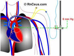 Cvp refects the amount of blood returning to the . Untitled Document