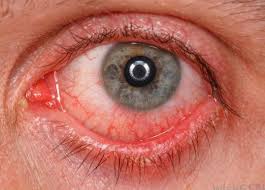 Red, painful and bloodshot eyes? Q A Monday Bloodshot Eyes When You Wake Up