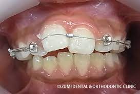 May 27, 2021 · 敵「出っ歯ひどいから矯正だけしても多分そこまで良くならんけどやるか？ 117: å­ä¾›ã®å‡ºã£æ­¯ ä¸Šé¡Žå‰çª 8æ­³ 10æ­³ 11æ­³ 13æ­³