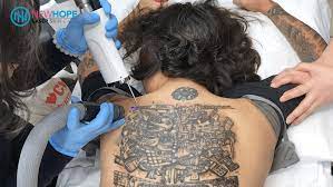 To understand how lasers work, it's crucial to get your head around what tattoos actually are first. Pico Laser Tattoo Removal Technology Myth Or Reality Phuong Q Tien Md Aesthetic Specialist