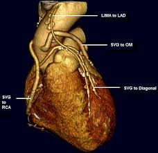 If a ramus intermedius artery is present, the diagonal arteries are. Three Dimensional Reconstruction With Volume Rendering Techniques Download Scientific Diagram