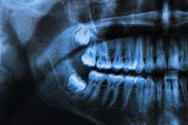 Somit besitzt der mensch in der regel vier. Weisheitszahne Ganz Hinten Wachst Noch Was Stern De