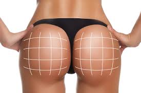 916 sagging buttocks products are offered for sale by suppliers on alibaba.com, of which pilates accessories accounts for 1%. Options For Correcting Sagging Buttocks Plastic Surgeon Cosmetic Surgeon