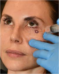 Image result for Forehead Regional Block