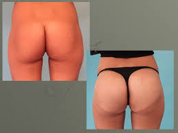 Tout comme pour l'augmentation mammaire, les implants fessiers sont en silicone et sont insérés le prix reste bien sûr important, mais il ne faut pas tomber dans le piège des chirurgies à rabais. Augmentation Des Fesses Clinique Des Houx