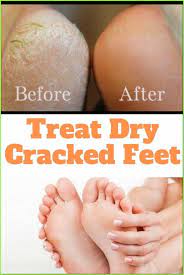 Overnight Peel Off Beauty Mask Wake Up Pretty Like A Princess In 2021 Dry Cracked Feet Cracked Feet Dry Feet Remedies