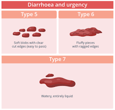 Image result for blood in stool human poop