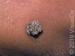 Flat warts usually occur on your face, hands, and feet. Patient Education Common Warts Plantar Warts And Flat Warts Beyond The Basics Uptodate