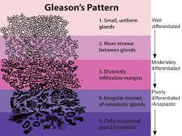 gleason grading system wikipedia