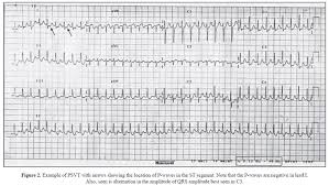 Common dysrhythmias in children, especially in infancy. Paroxysmal Narrow Qrs Tachycardia