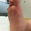 Foot fungus treatment at home: 1
