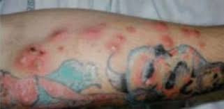 Collection by destiny • last updated 7 weeks ago. 10 What Does Tattoo Ink Poisoning Look Like
