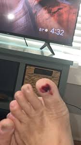 Image result for Onychotillomania feet