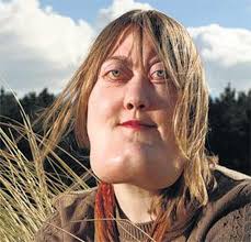 Cherubism has historically been considered a variant of fibrous dysplasia, but in reality is likely a distinct entity. Seriously Strange On Twitter There Is A Rare Genetic Disorder Called Cherubism That Causes The Lower Half Of The Face To Grow Excessively Large Http T Co S24rf3g49r