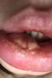 Es sieht nicht wie herpes aus. Allergische Reaktion Nach Lippenaufspritzen Sally Roberts Erleidet Hollenqualen