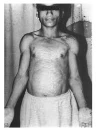 Berardinelli seip congenital lipodystrophy (bscl) is a rare metabolic disorder characterized by severe generalized lipodystrophy, insulin resistance, and dyslipedemia since infancy, and onset of overt. Seip Berardinelli Lipodystrophy Report Of Three Cases And Their Endocrine Functions Annals Of Saudi Medicine