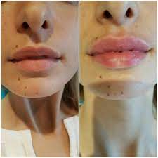 Uzrokovano je istjecanjem krvi iz ozlijeđenih žila u okolno tkivo. Sve Sto Treba Da Znate O Povecanju Usana Sito Reseto