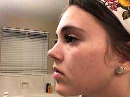 REVERSE!! I have been using this product for a few weeks ( I know, I used  REDEFINE for SOOO long) and I absolutely LOVE IT!!! { This regimen is best  used if