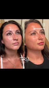 💋To ensure your results keep you looking authentically you, I provide a,  personalized treatment plan to identify the ideal volume and shape that  complements your facial features. , 💋I will discuss ...