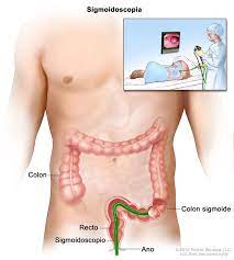 Las paredes del colon sigmoide son musculares, y se contraen para incrementar la presión en el interior del colon, haciendo que los excrementos se muevan hacia el recto. Sigmoidoscopia Flexible Niddk