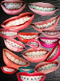 Hat ni macam paling terang ja haha. Tentang Fake Braces Click Braces Clip Viral Rm45 Facebook