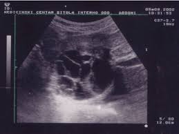 We did not find results for: Ultrasound Of Echinococcal Liver Cysts