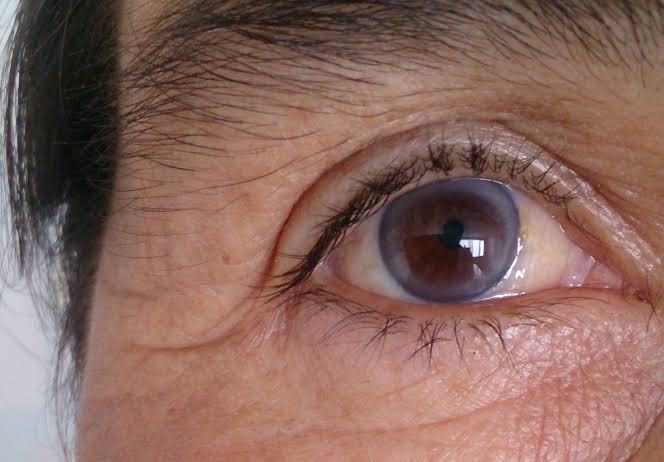 Corneal Arcus: What the Ring Around Your Cornea Means