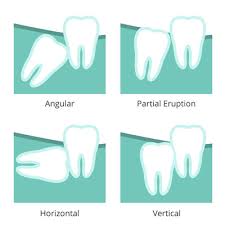 Removal of a wisdom tooth can vary from being relatively easy to extremely difficult. Wisdom Teeth Removal Currambine Kinross Iluka Wa