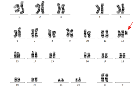 There is usually a mixture of cells (mosaicism), some with extra #12 material, and some that are normal (46 chromosomes without the extra #12 material). Oman Medical Journal Archive