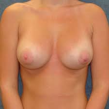 Before & After Tuberous Breast Surgery in Stafford VA | Belmont Plastic  Surgery