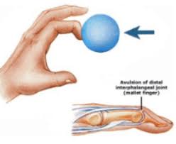 If your finger is not broken or cut, or if only a small fracture is present, the doctor will apply a splint to the end of the finger so it remains extended. What Should I Do About My Mallet Finger Oh My Arthritis