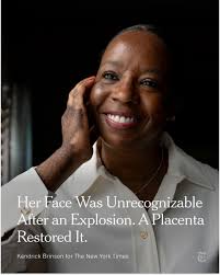A propane explosion left Marcella Townsend's face unrecognizable. Then  doctors turned to a surprising tool to repair it: human placenta. She still  has scars elsewhere