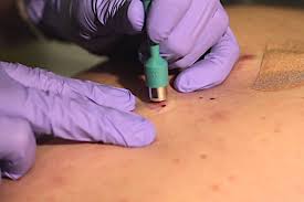 A doctor uses a skin biopsy to diagnose skin conditions and remove abnormal tissue. Blog Three Types Of Skin Biopsies