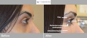 Before and 6 weeks after eye plastic surgery photos are shown. Canthoplasty Photos Mehryar Ray Taban Md