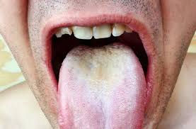 Image result for brown tongue symptoms