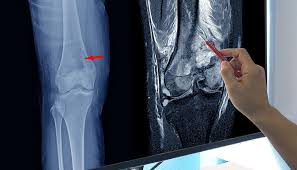 Image result for Knee XRay