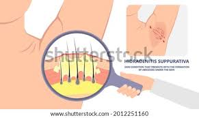 This process not only causes unsightly red bumps. Wbelko5frnrwsm