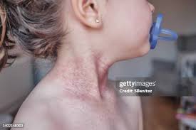 Image result for dermatitis contacta children