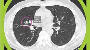 The symptoms of a secondary lung cancer may be distressing, and can include: Ai Breakthrough Could Speed Up Lung Cancer Diagnosis And Save The Nhs Millions