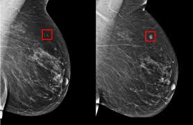 In diagnosing inflammatory breast cancer and other breast cancer types and staging the disease metastatic cancer detection. Mit Csail S Ai Can Predict The Onset Of Breast Cancer 5 Years In Advance Venturebeat