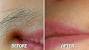 Threading Upper Lip Regrowth