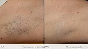 Since the hair follicle will be damaged, it will not be able to grow. Coolglide Laser Hair Removal Lakes Dermatology