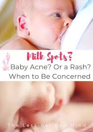May 18, 2020 · breastmilk and infant formula while introducing solids. Milk Rash Vs Baby Acne Vs Milk Spots Identify Your Baby S Condition