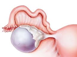 complex ovarian cyst symptoms risks pictures surgery