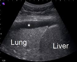 Pleural effusions may result from pleural, parenchymal, or extrapulmonary disease. Pleural Space Infections Empyema Pulmonology Advisor