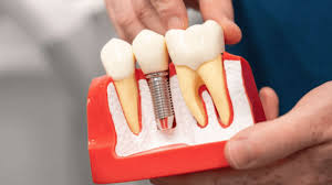 The Top 5 Myths About Dental Implants—Debunked! | Dental Implants Mermaid  Waters QLD