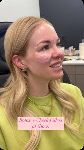 Come with me to get Botox + cheek filler at Glow!, 💉 the perfect  effortless youthful look