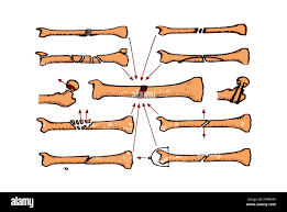 Image result for Fracture Complication