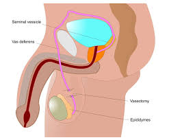 Apr 26, 2020 · a vasectomy reversal may cost between $3,000 and $15,000 and most health insurance companies will not cover this procedure. No Scalpel Vasectomy Male Birth Control Plano Frisco Dallas Tx